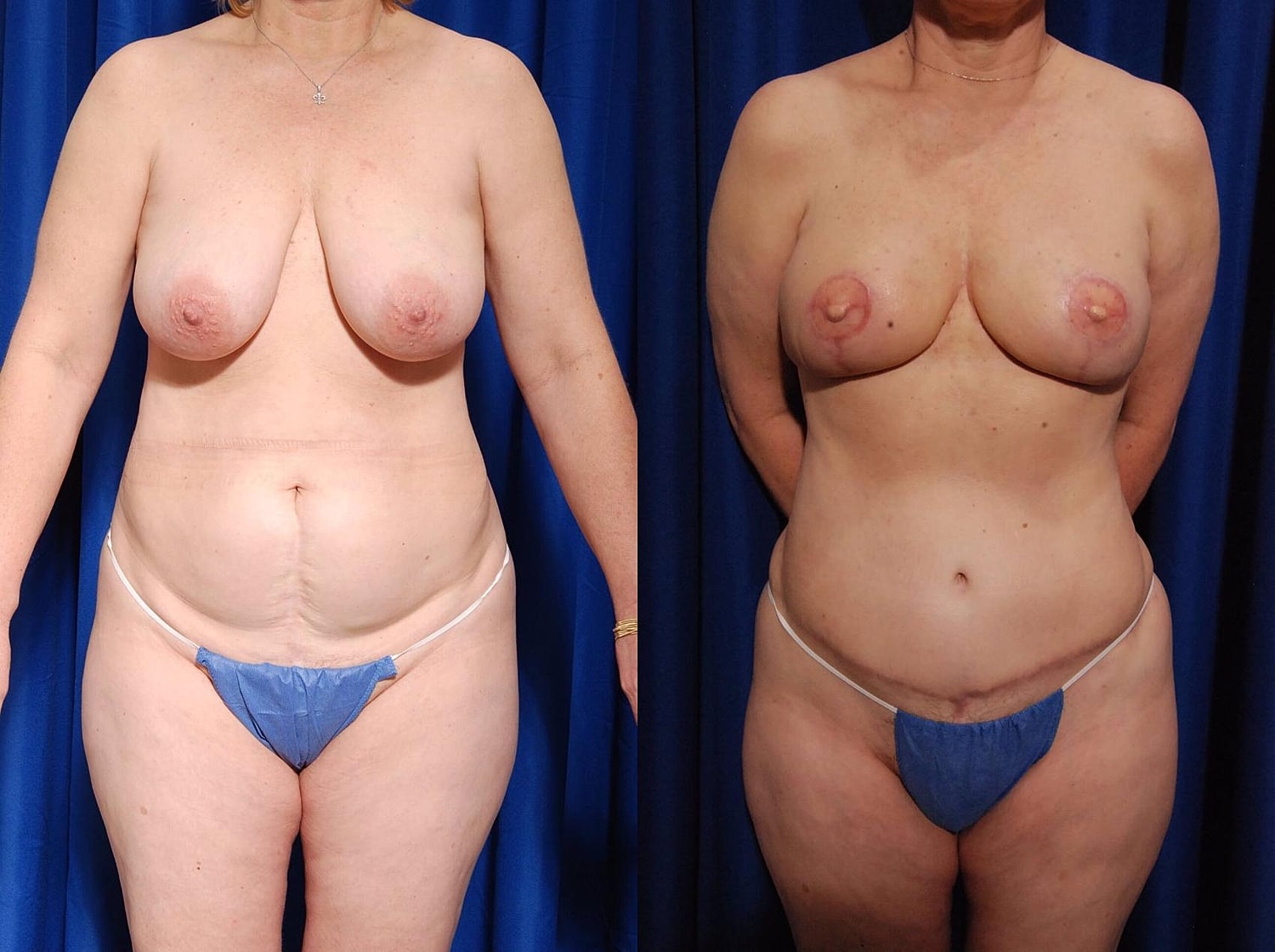 Breast Reconstruction Before & After