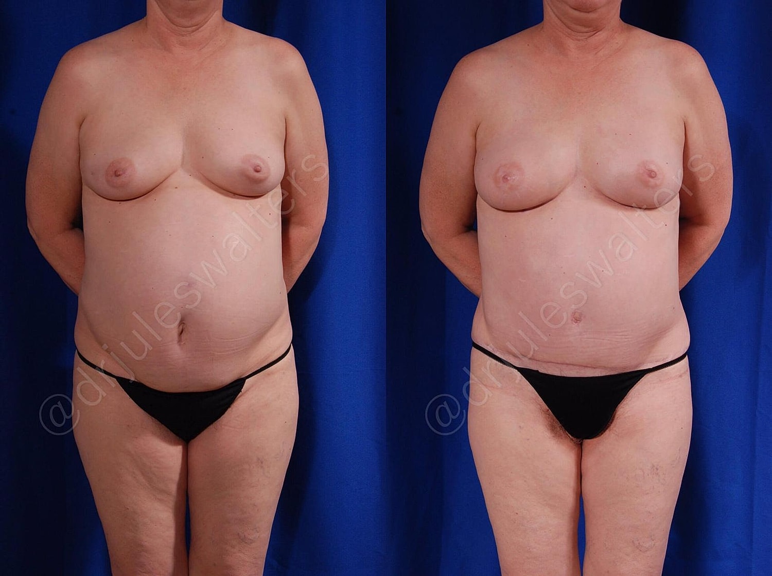 Breast Reconstruction Before & After