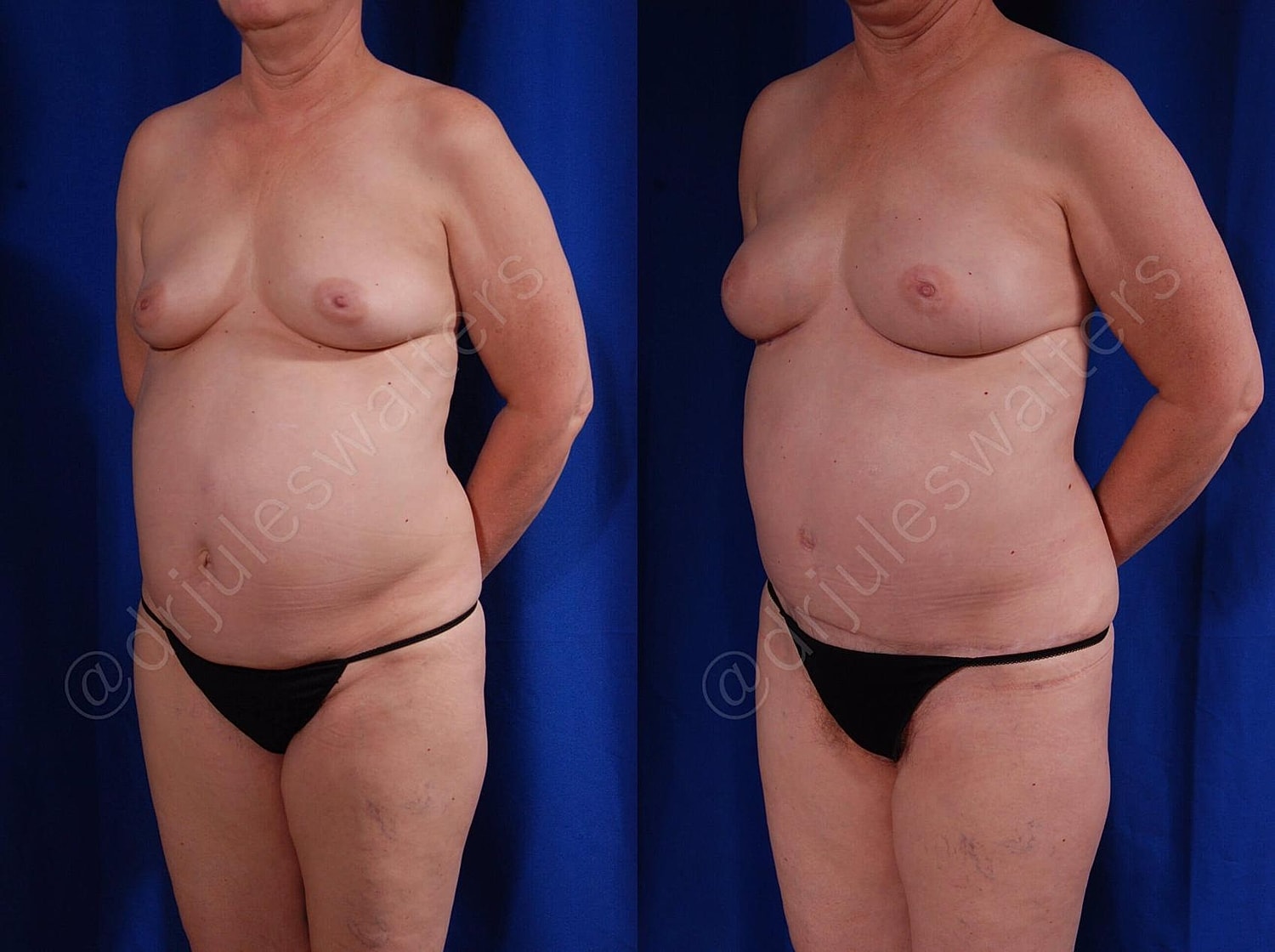 Breast Reconstruction Before & After