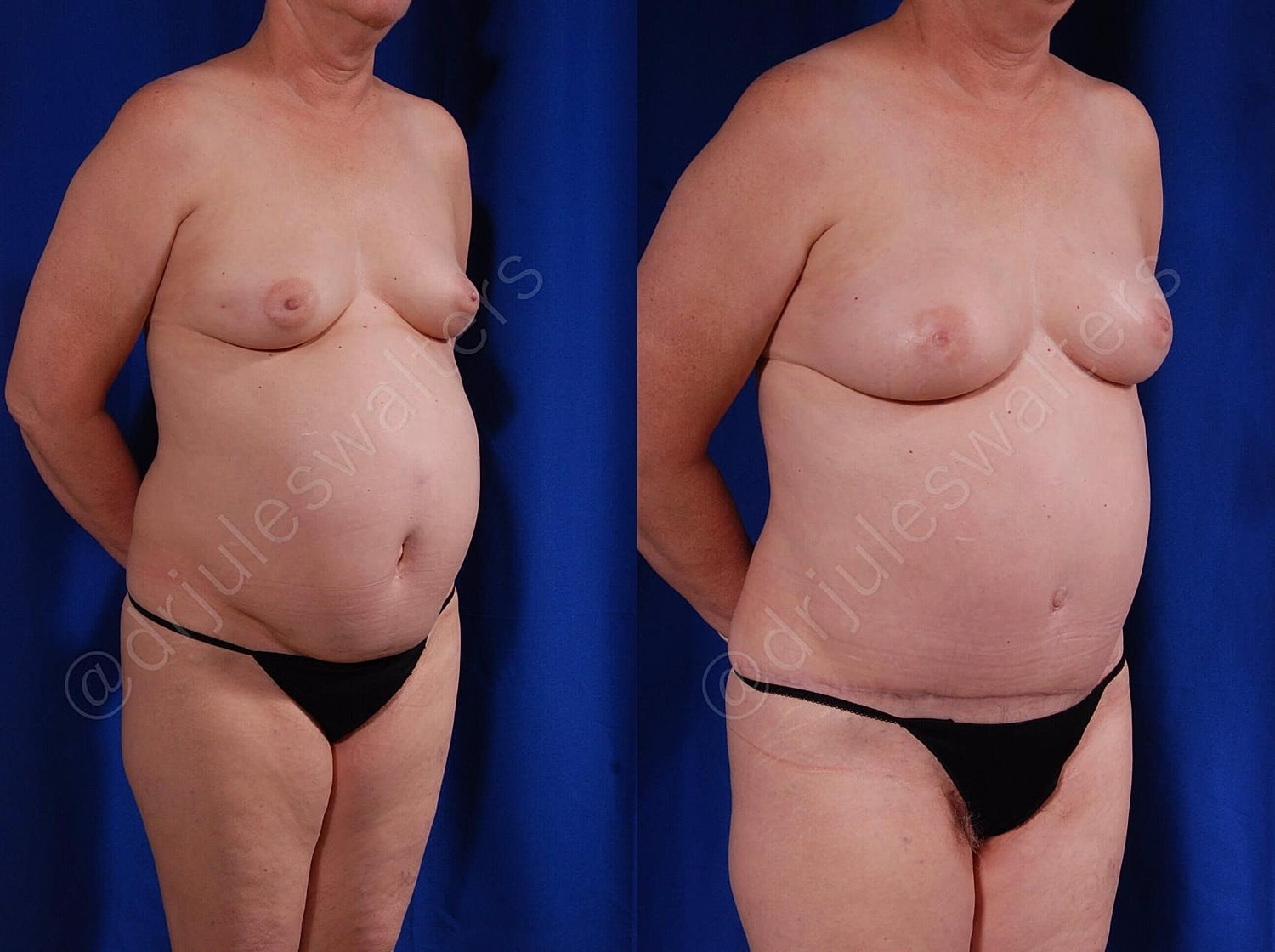 Breast Reconstruction Before & After