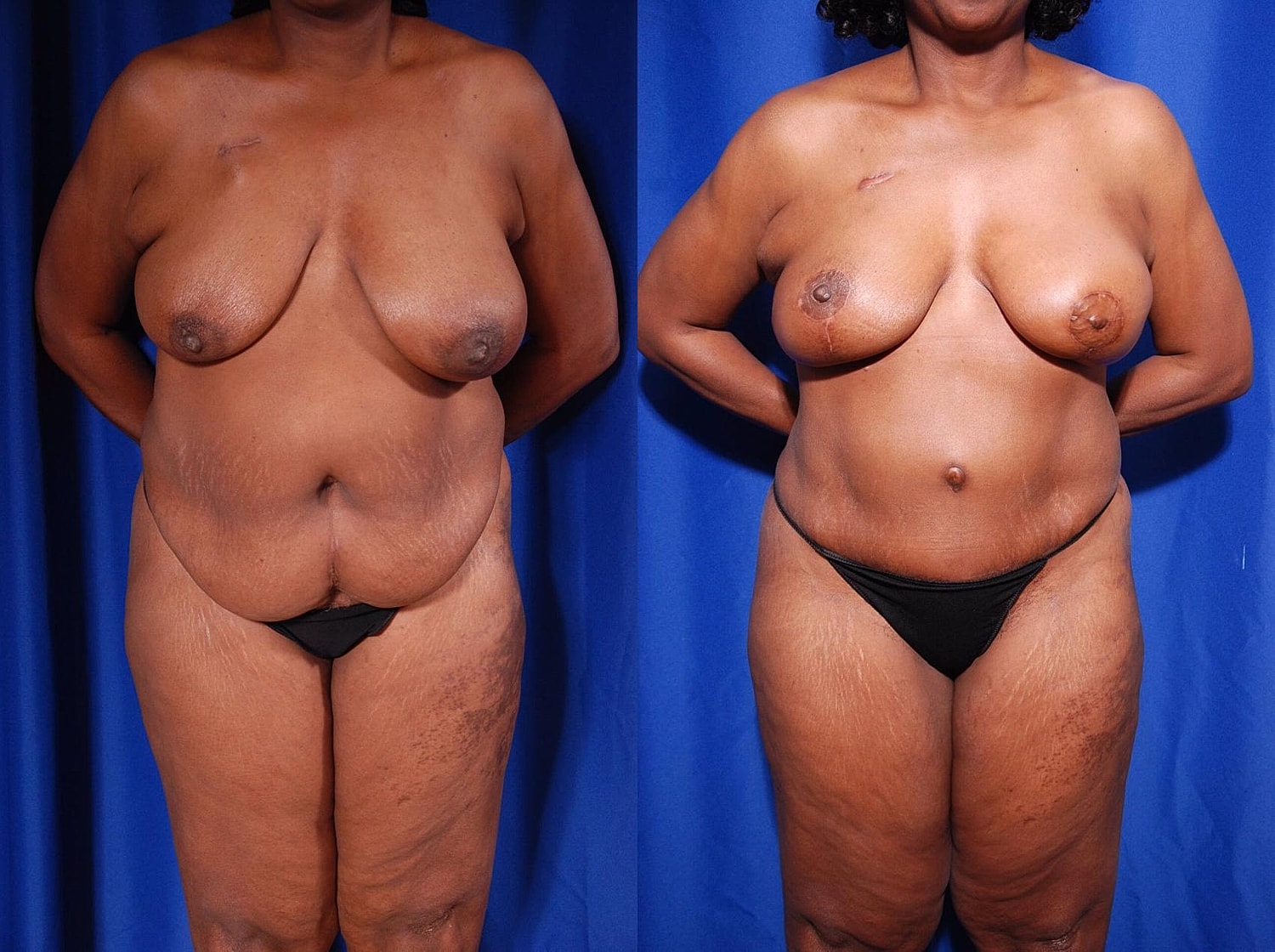Breast Reconstruction Before & After