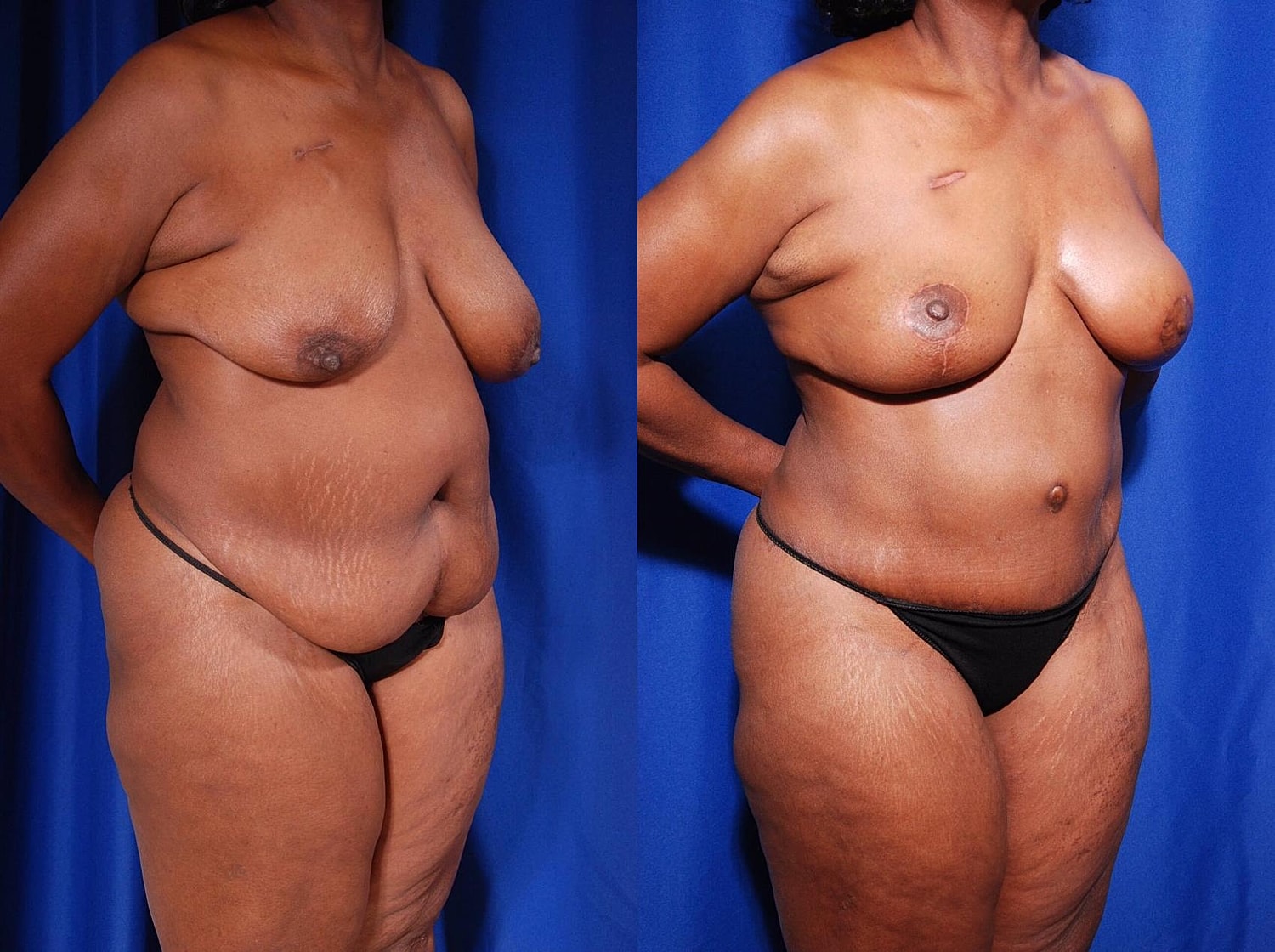 Breast Reconstruction Before & After