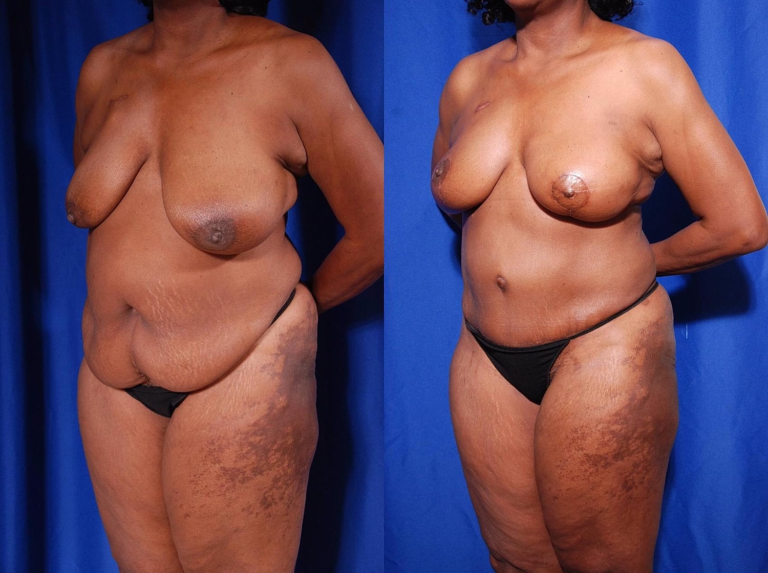 Breast Reconstruction Before & After