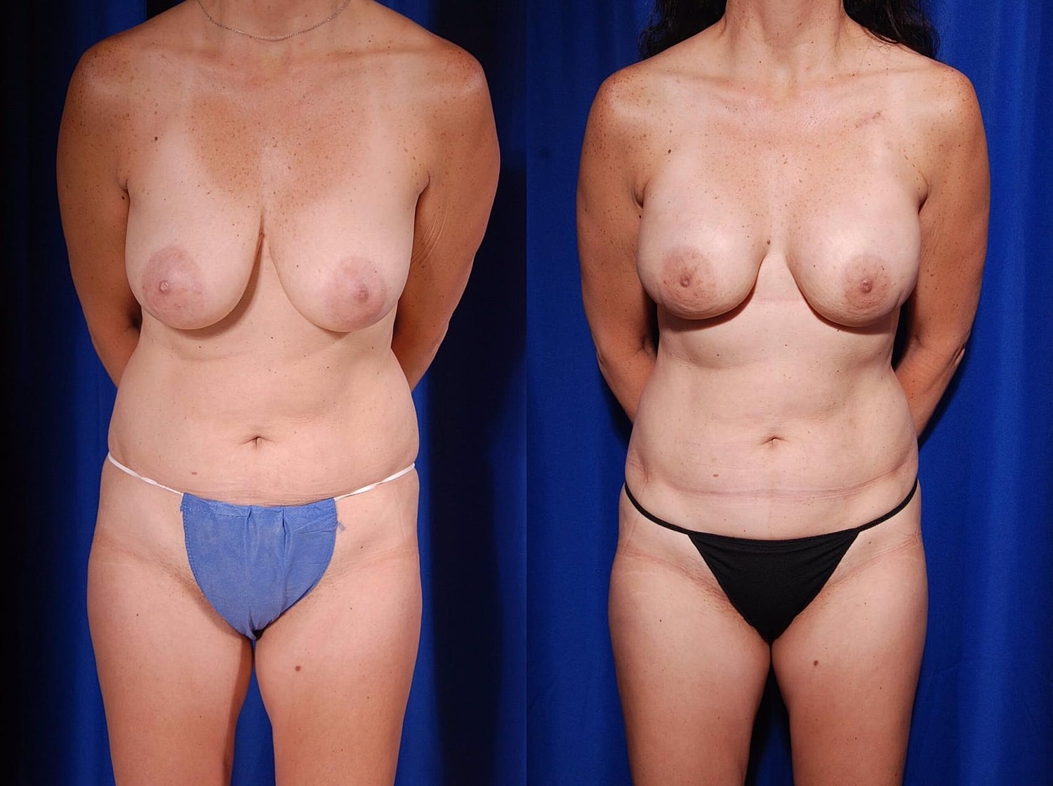 Breast Reconstruction Before & After
