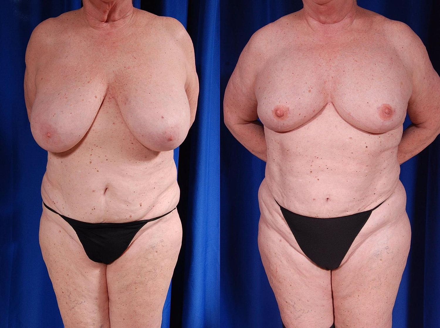 Breast Reconstruction Before & After