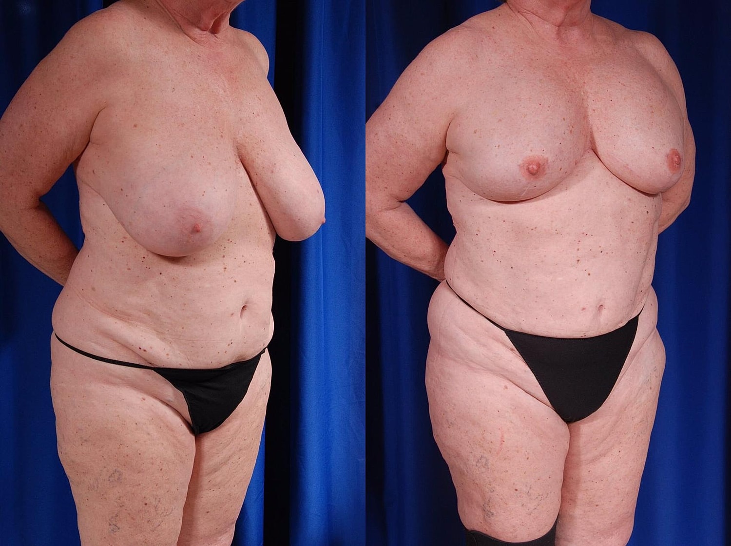 Breast Reconstruction Before & After