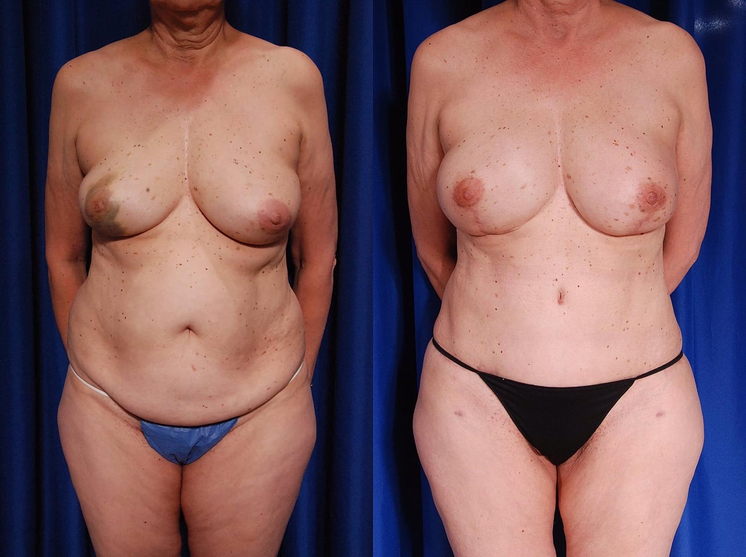Breast Reconstruction Before & After