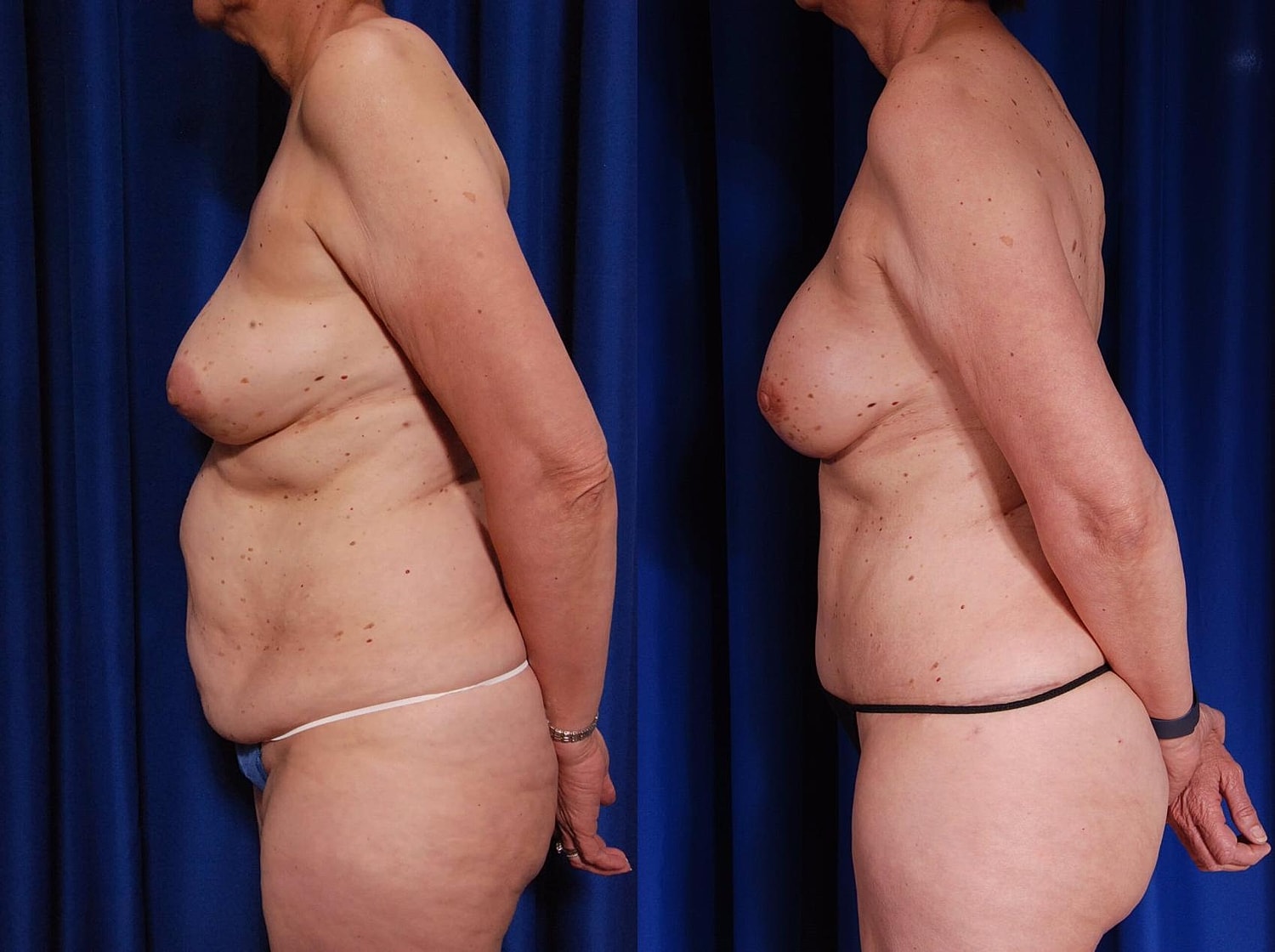 Breast Reconstruction Before & After