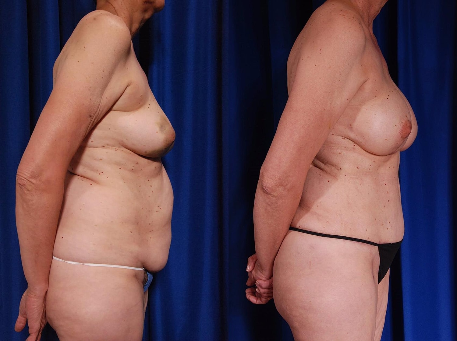 Breast Reconstruction Before & After