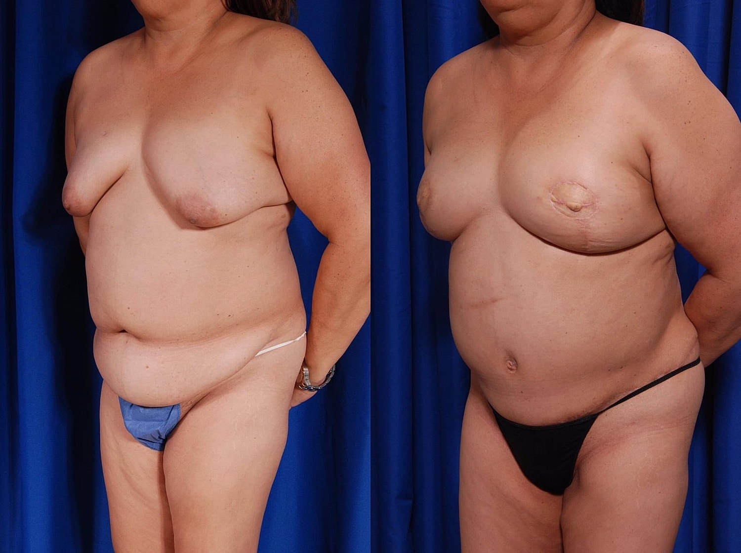 Breast Reconstruction Before & After
