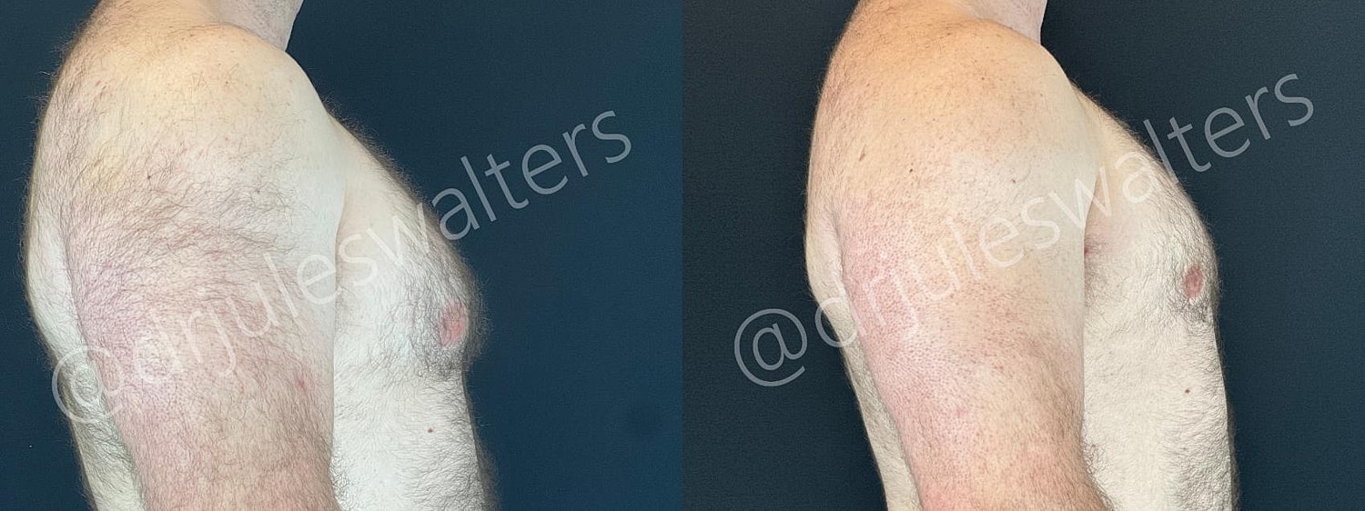 Gynecomastia Before & After