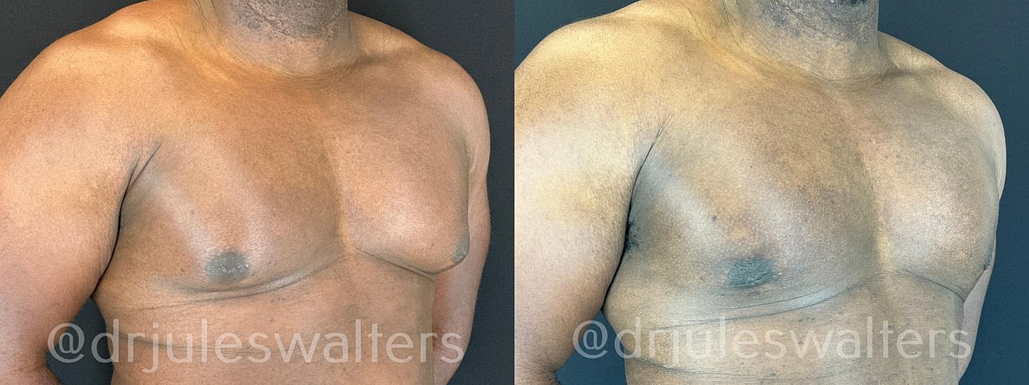 Gynecomastia Before & After