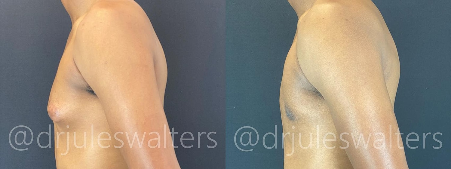 Gynecomastia Before & After