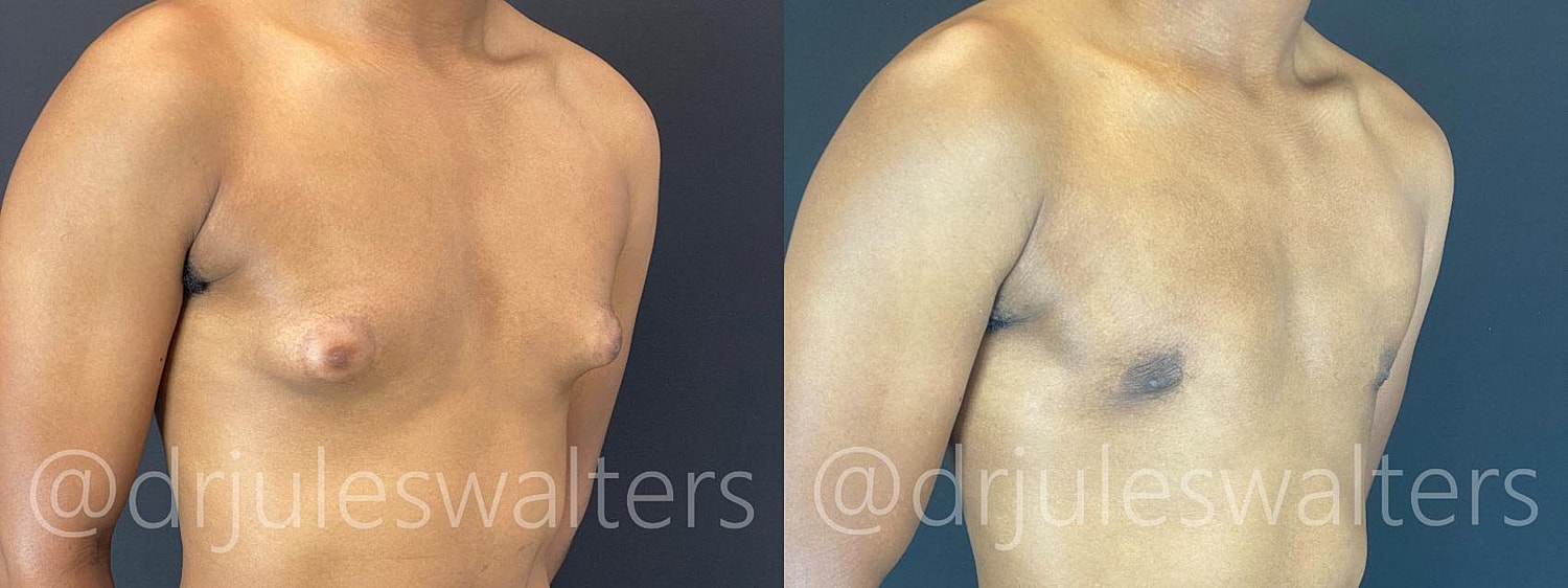 Gynecomastia Before & After