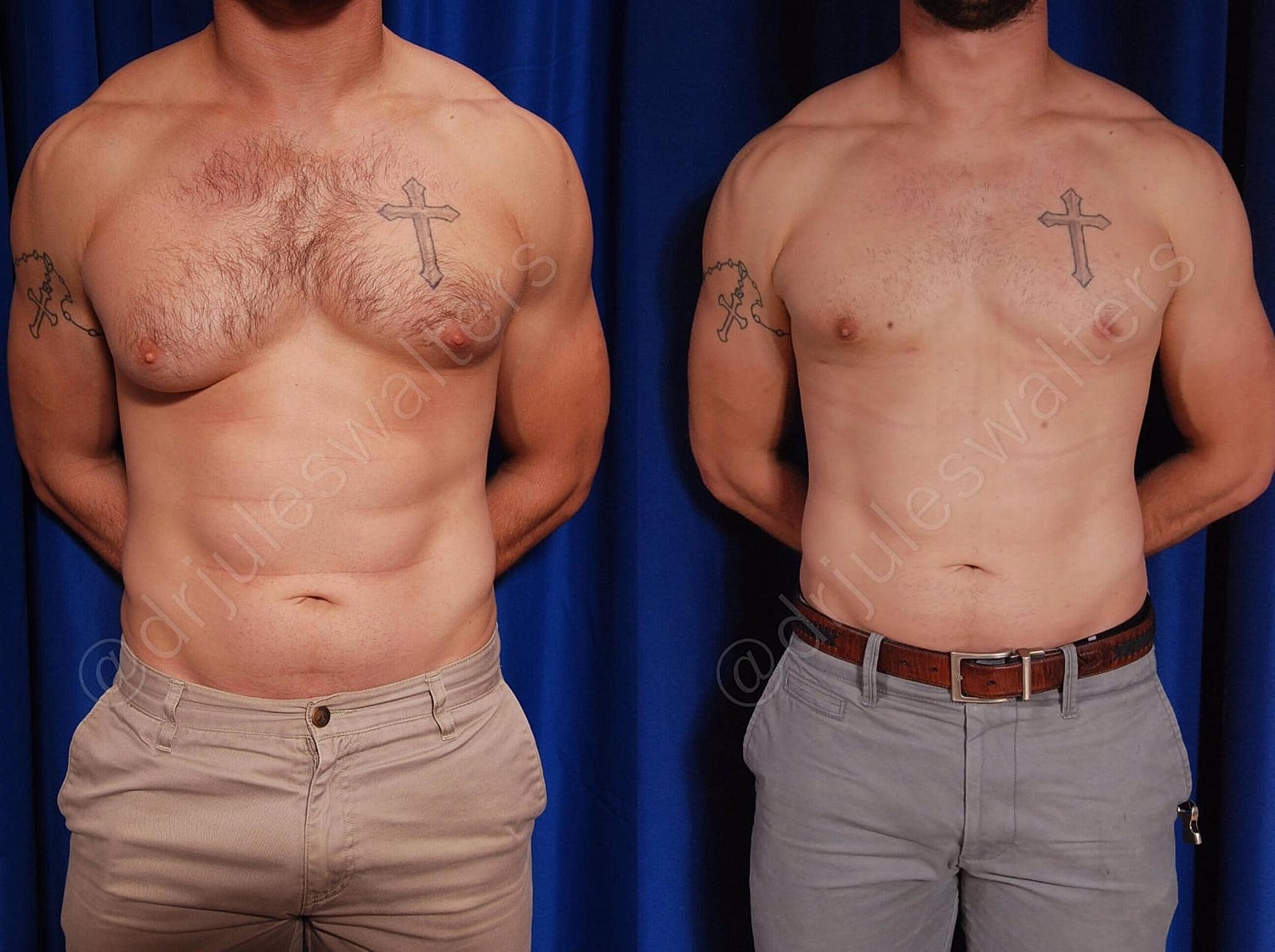 Gynecomastia Before & After
