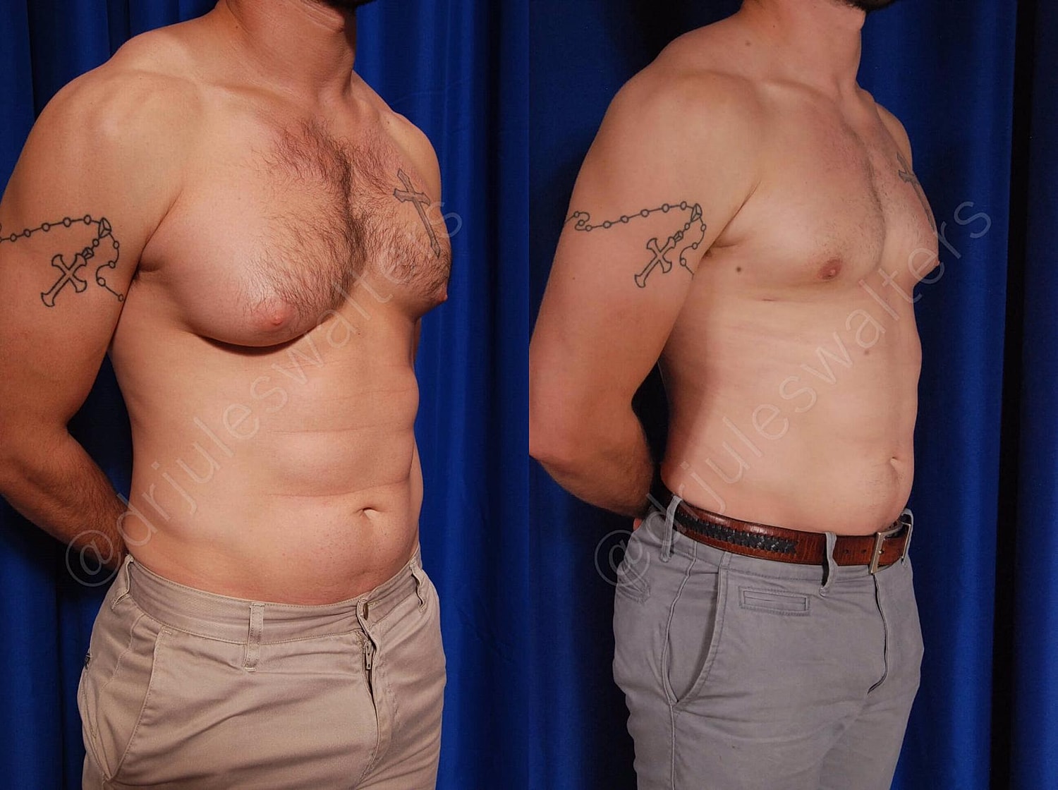 Gynecomastia Before & After