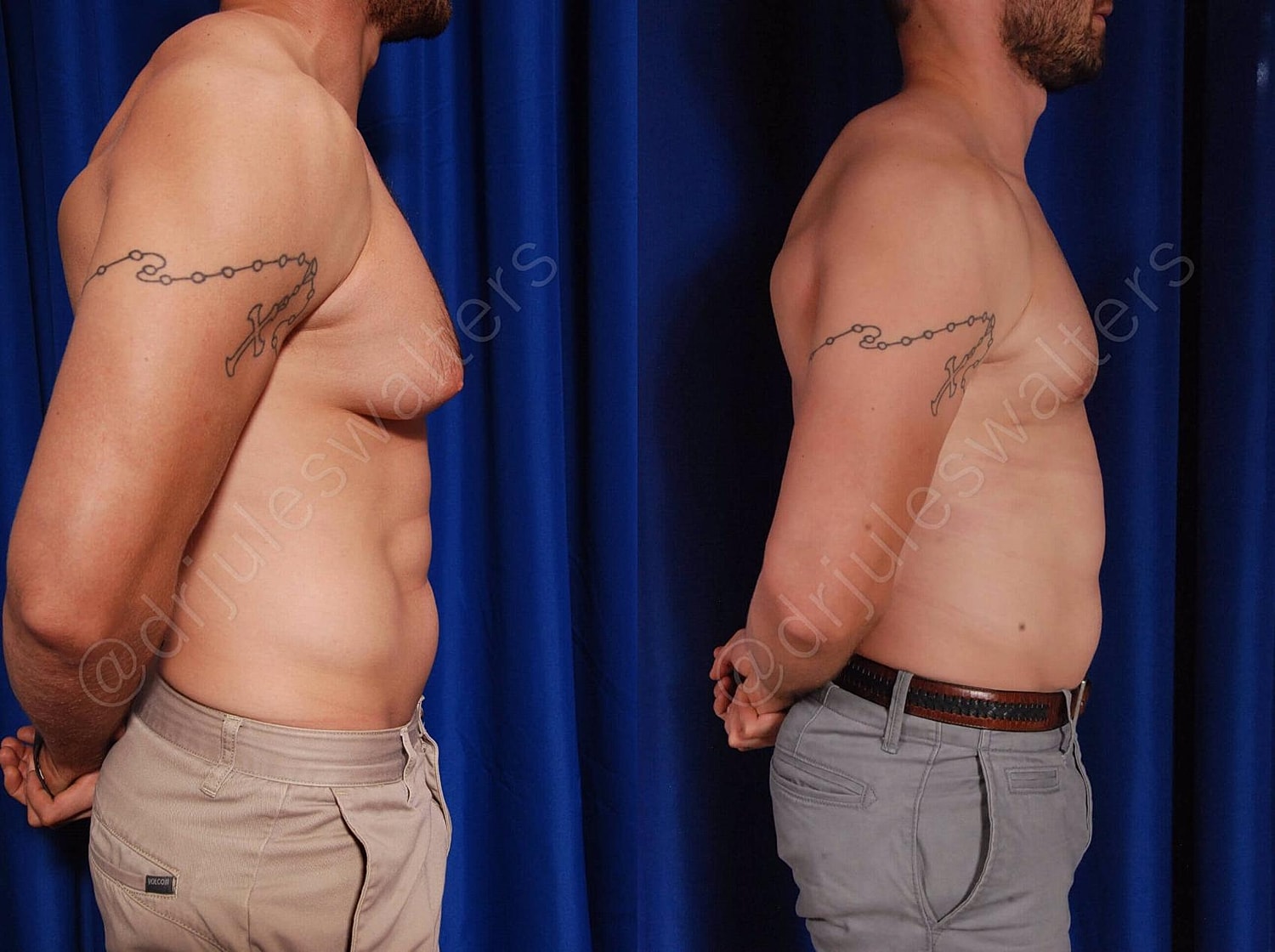 Gynecomastia Before & After
