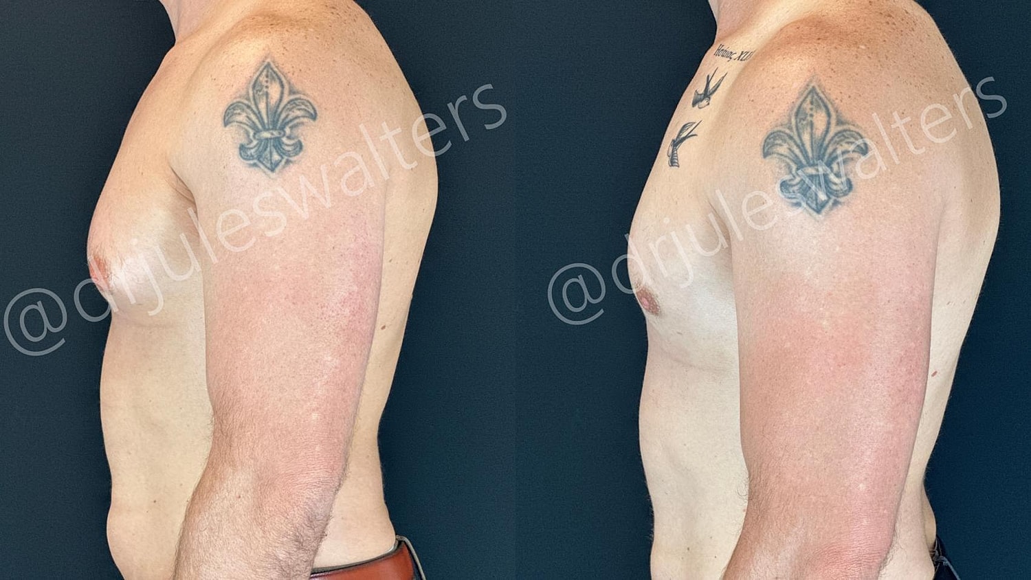 Gynecomastia Before & After