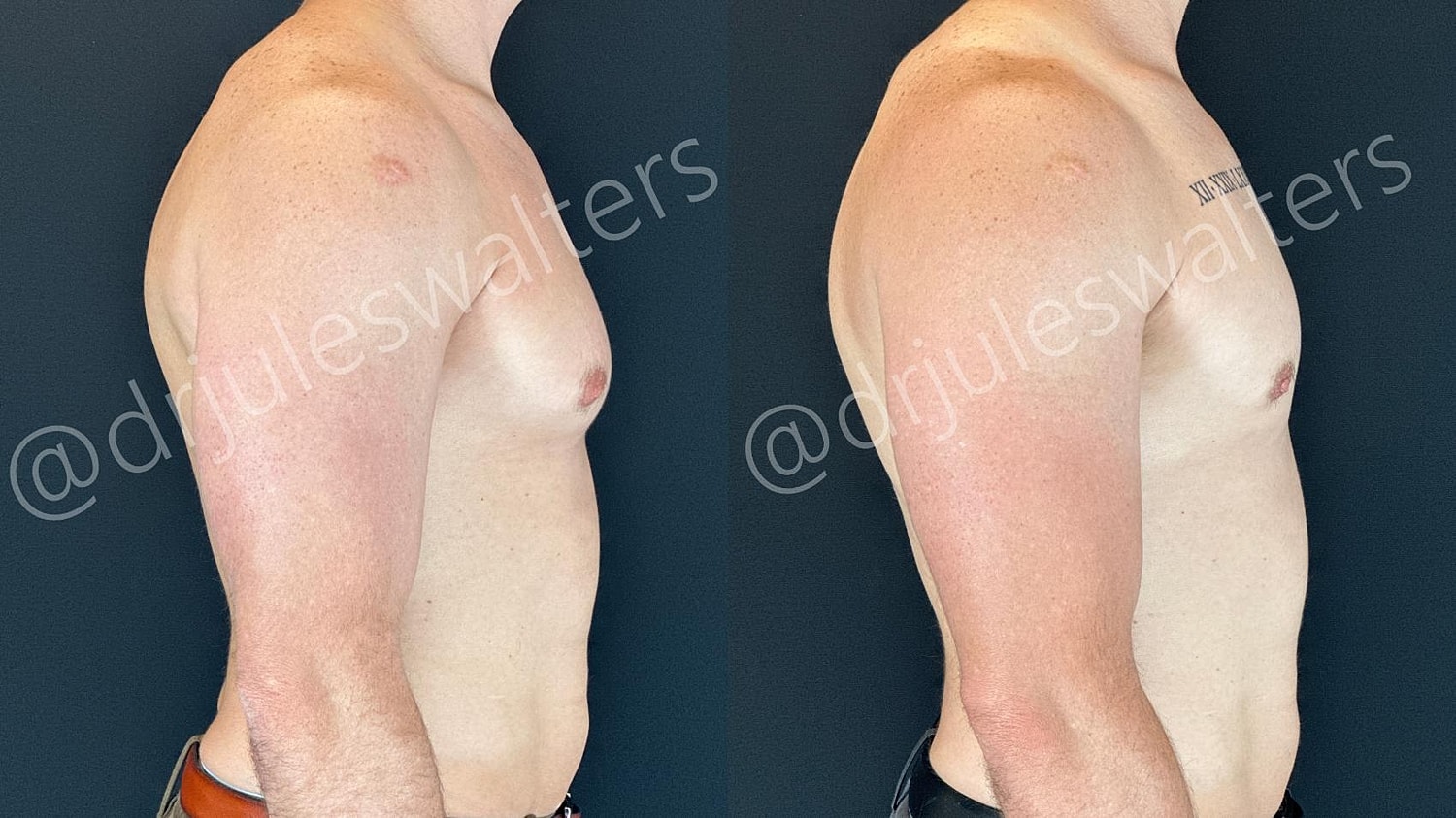 Gynecomastia Before & After