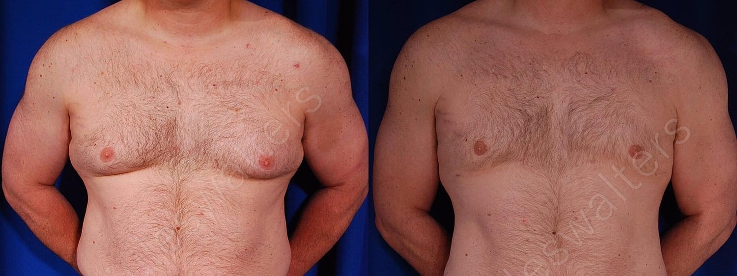Gynecomastia Before & After