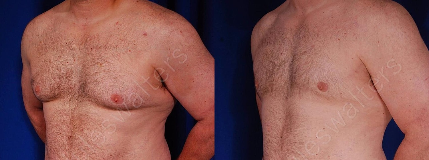 Gynecomastia Before & After