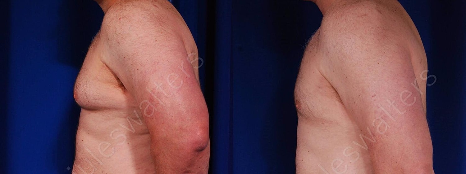 Gynecomastia Before & After