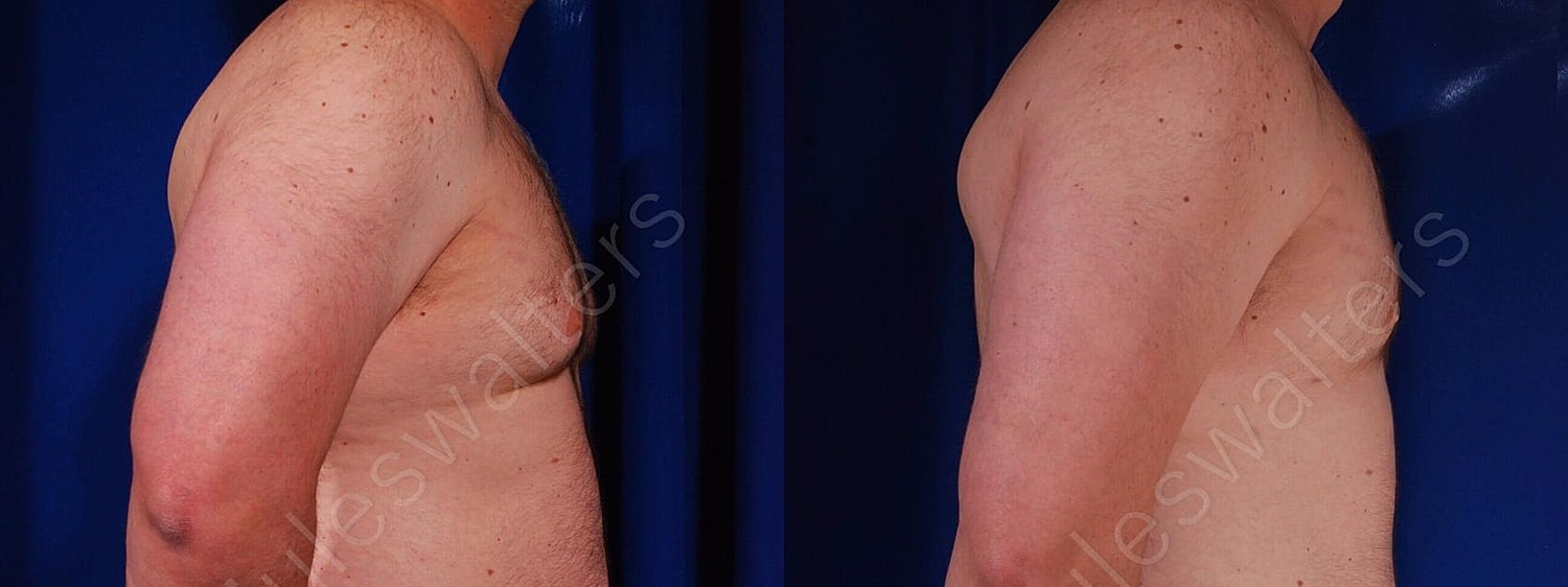Gynecomastia Before & After