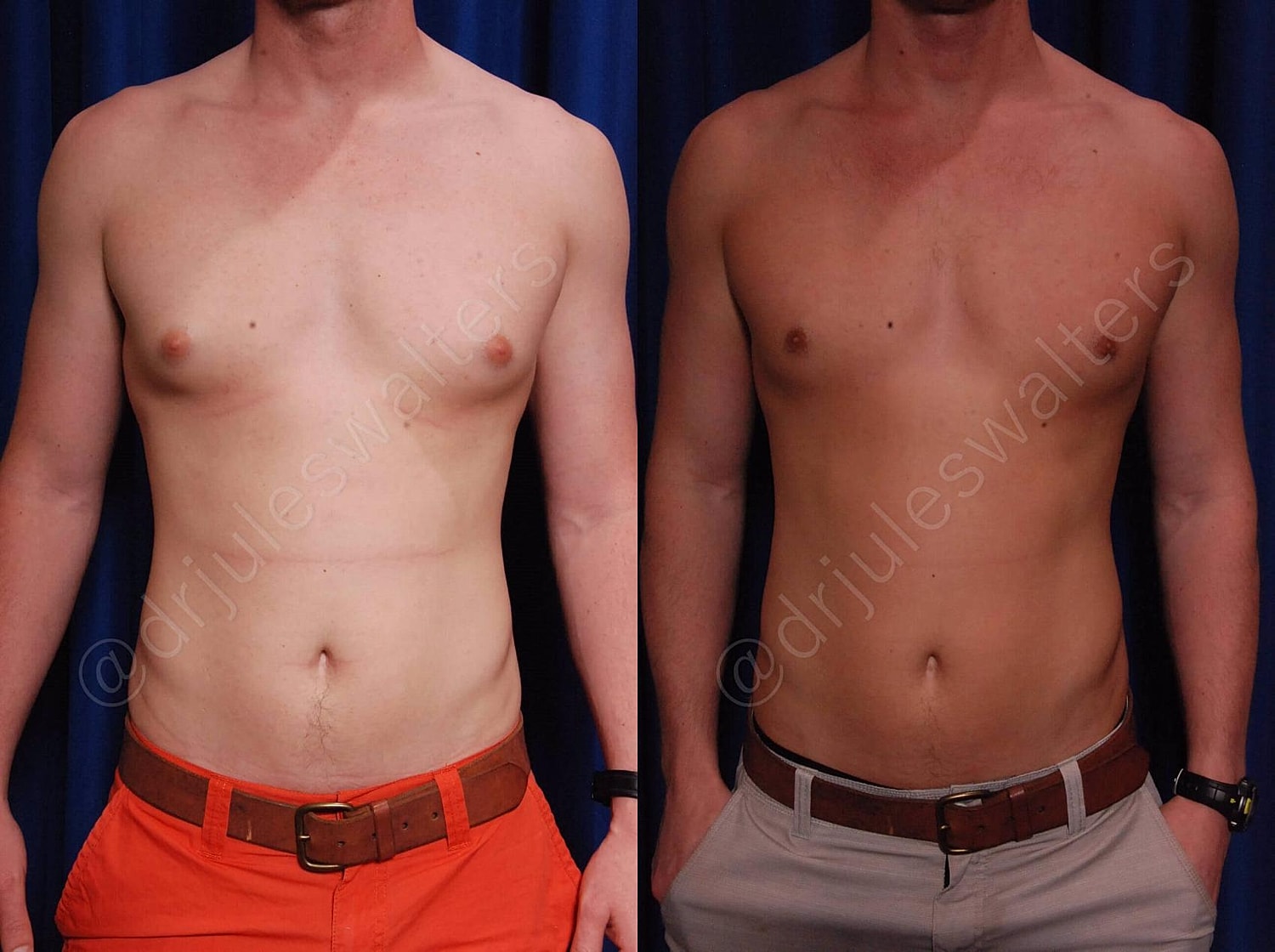 Gynecomastia Before & After