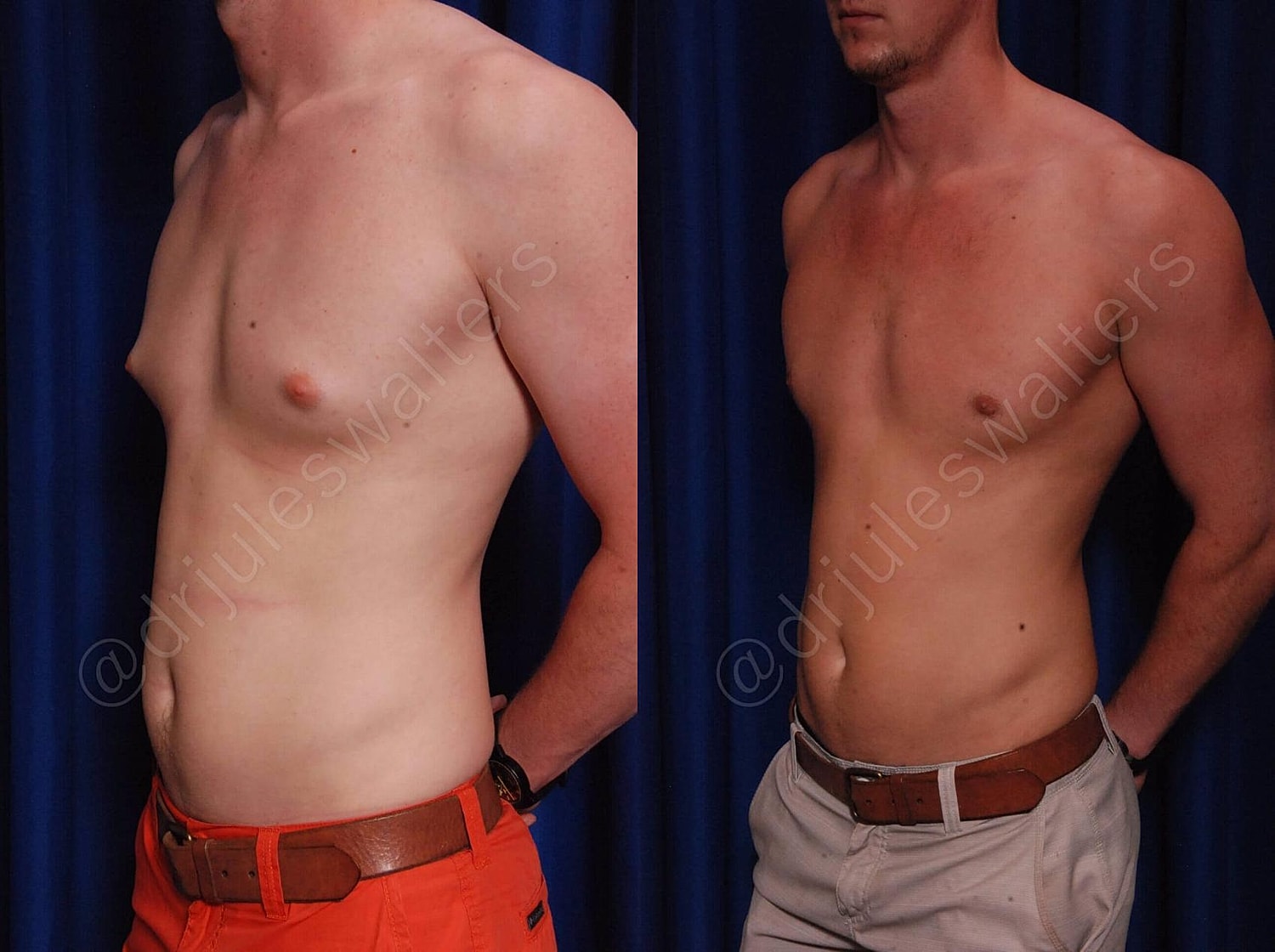 Gynecomastia Before & After