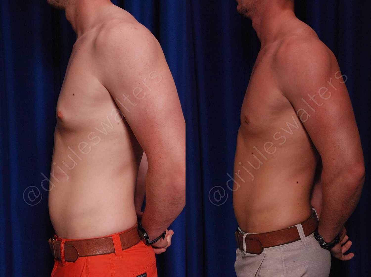 Gynecomastia Before & After