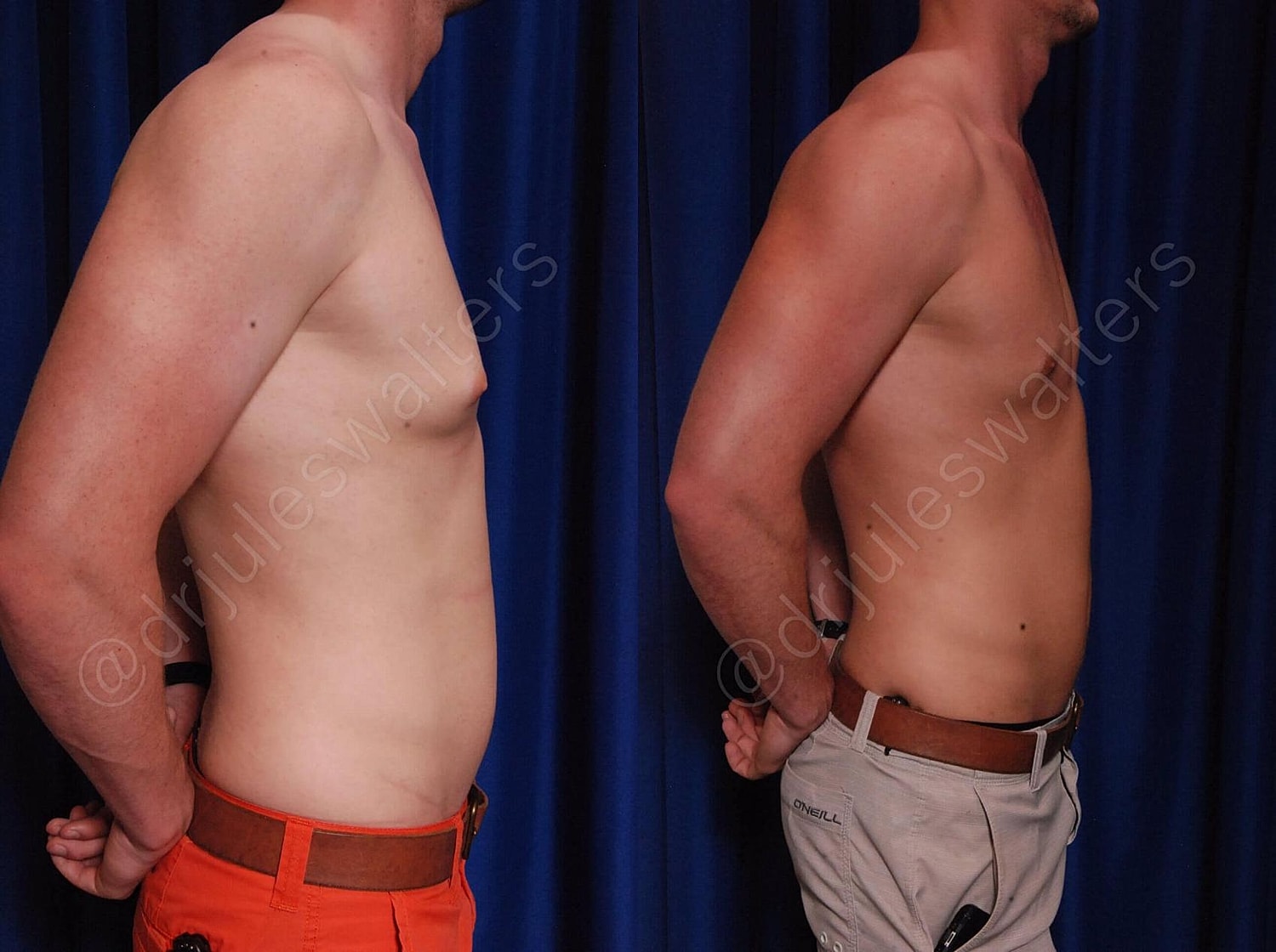 Gynecomastia Before & After