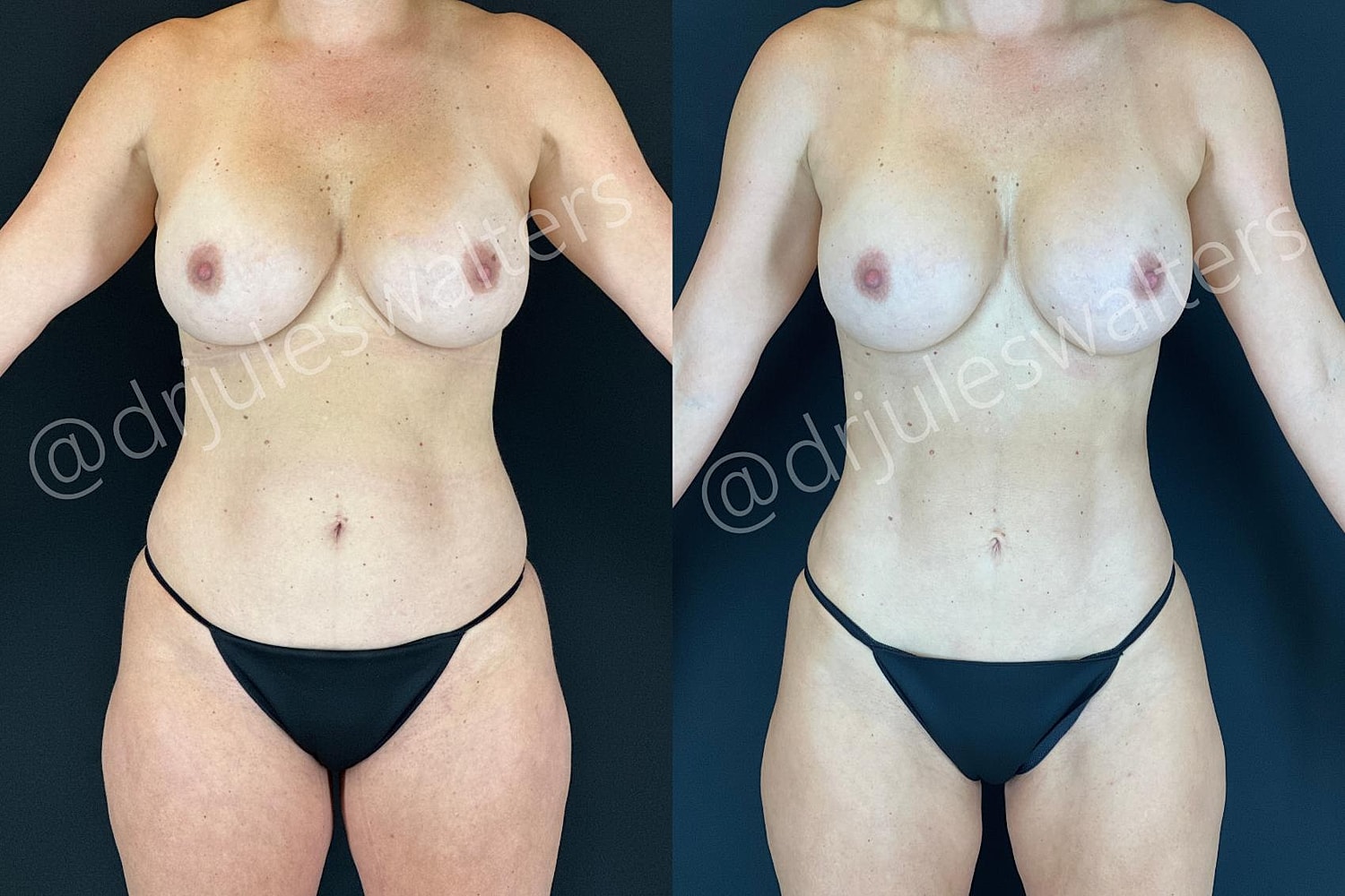 Vaserlipo Before & After