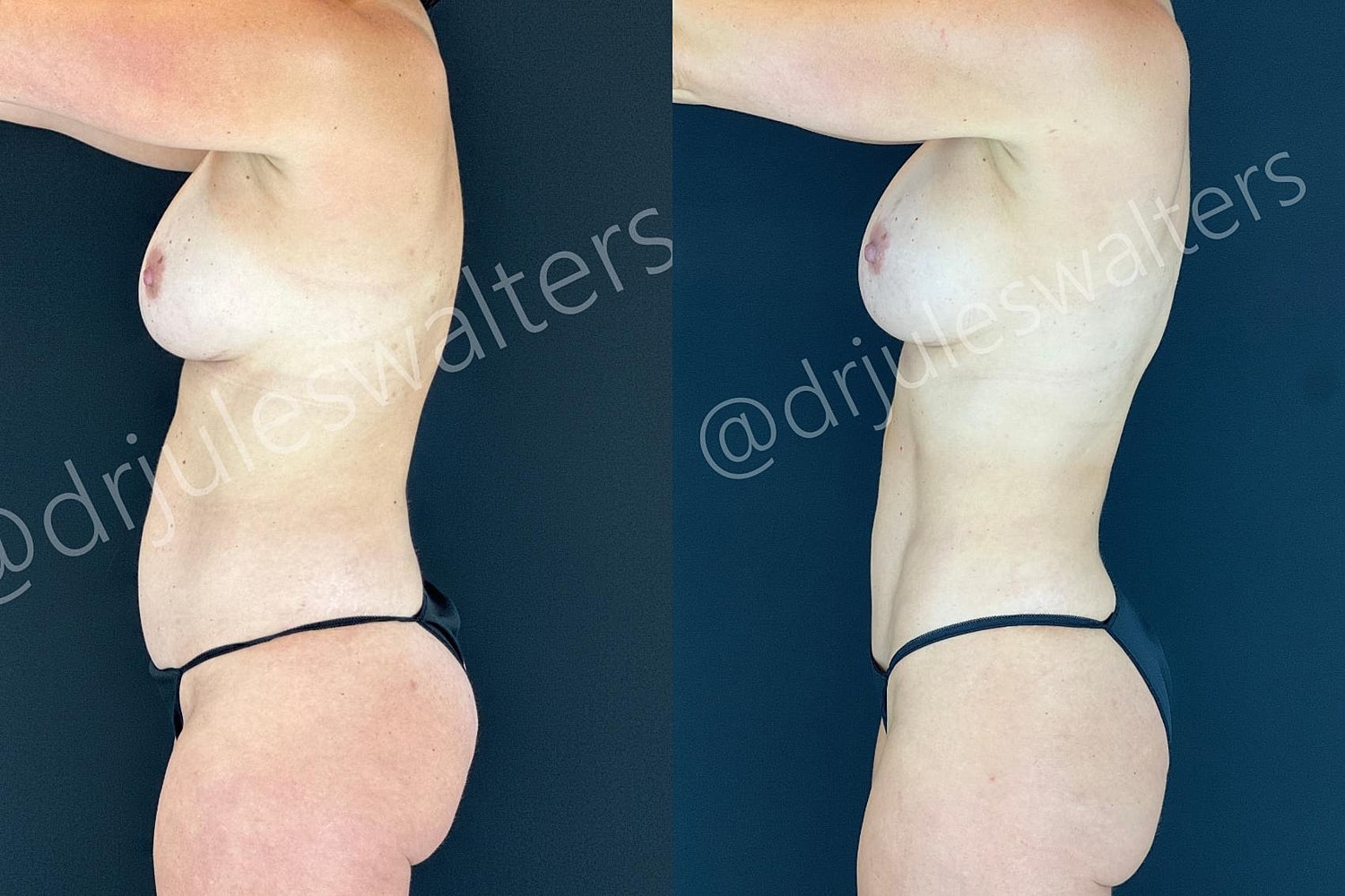 Vaserlipo Before & After