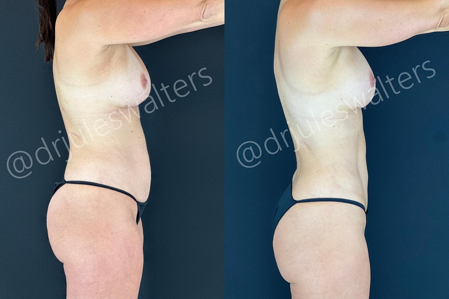 Vaserlipo Before & After
