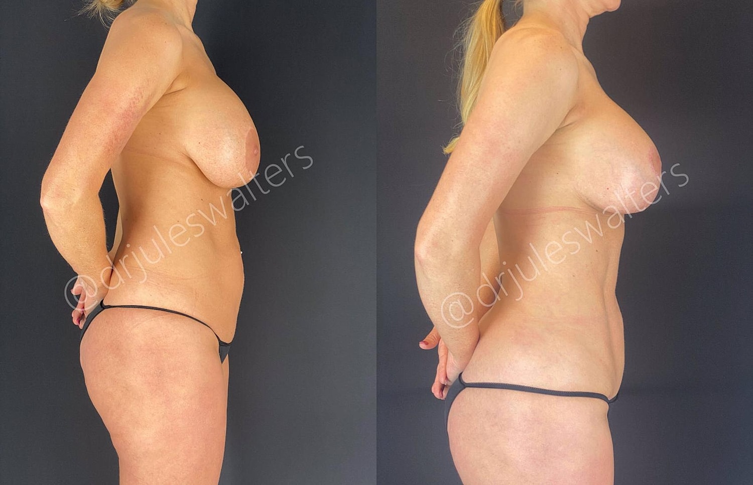 Vaserlipo Before & After