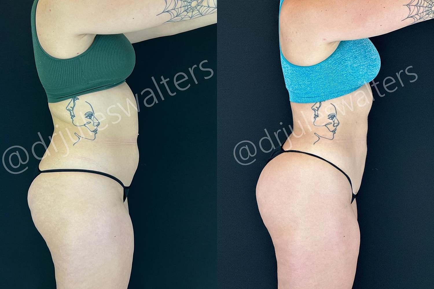 Vaserlipo Before & After