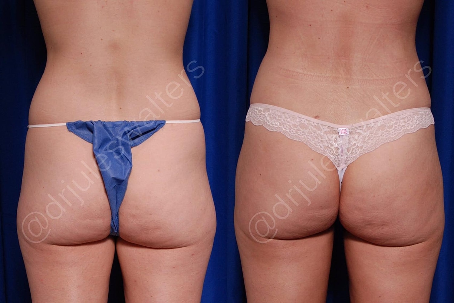 Vaserlipo Before & After