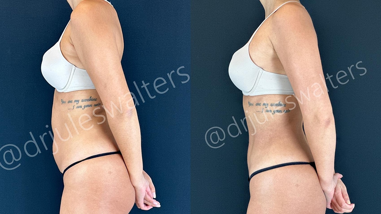 Vaserlipo Before & After