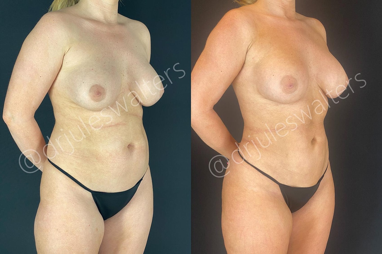 Vaserlipo Before & After