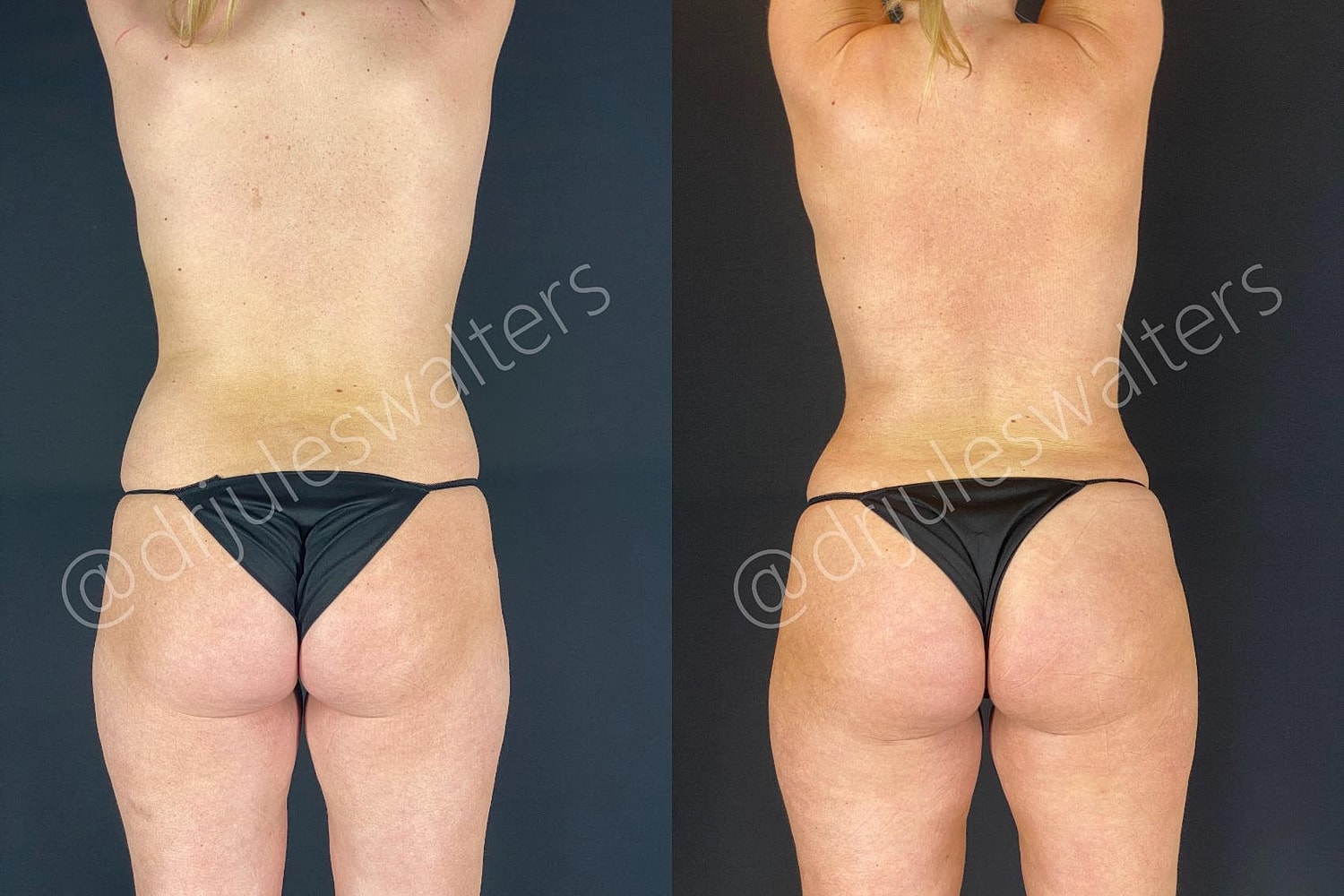 Vaserlipo Before & After