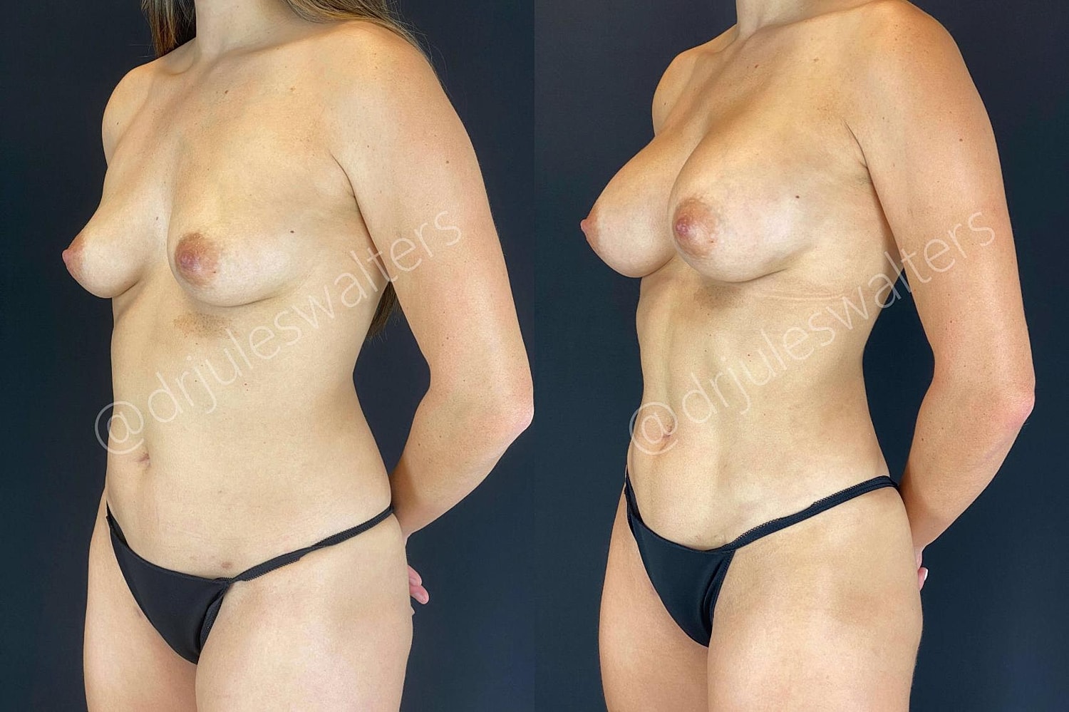 Vaserlipo Before & After