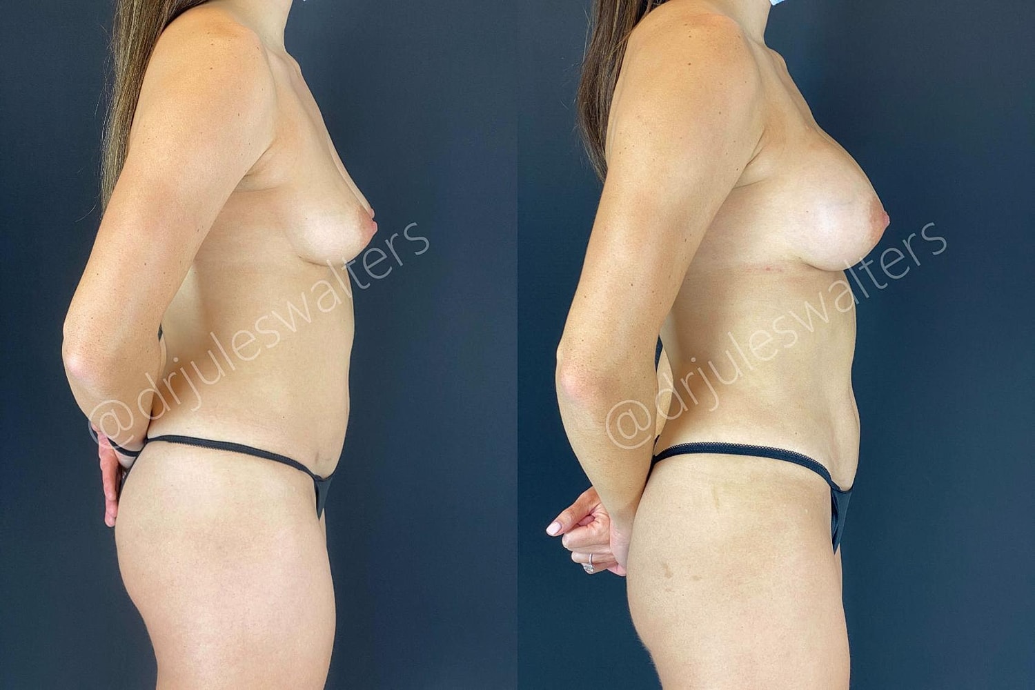 Vaserlipo Before & After