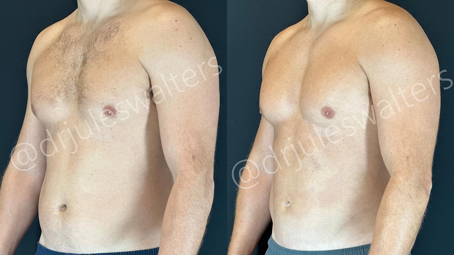 Vaserlipo Before & After
