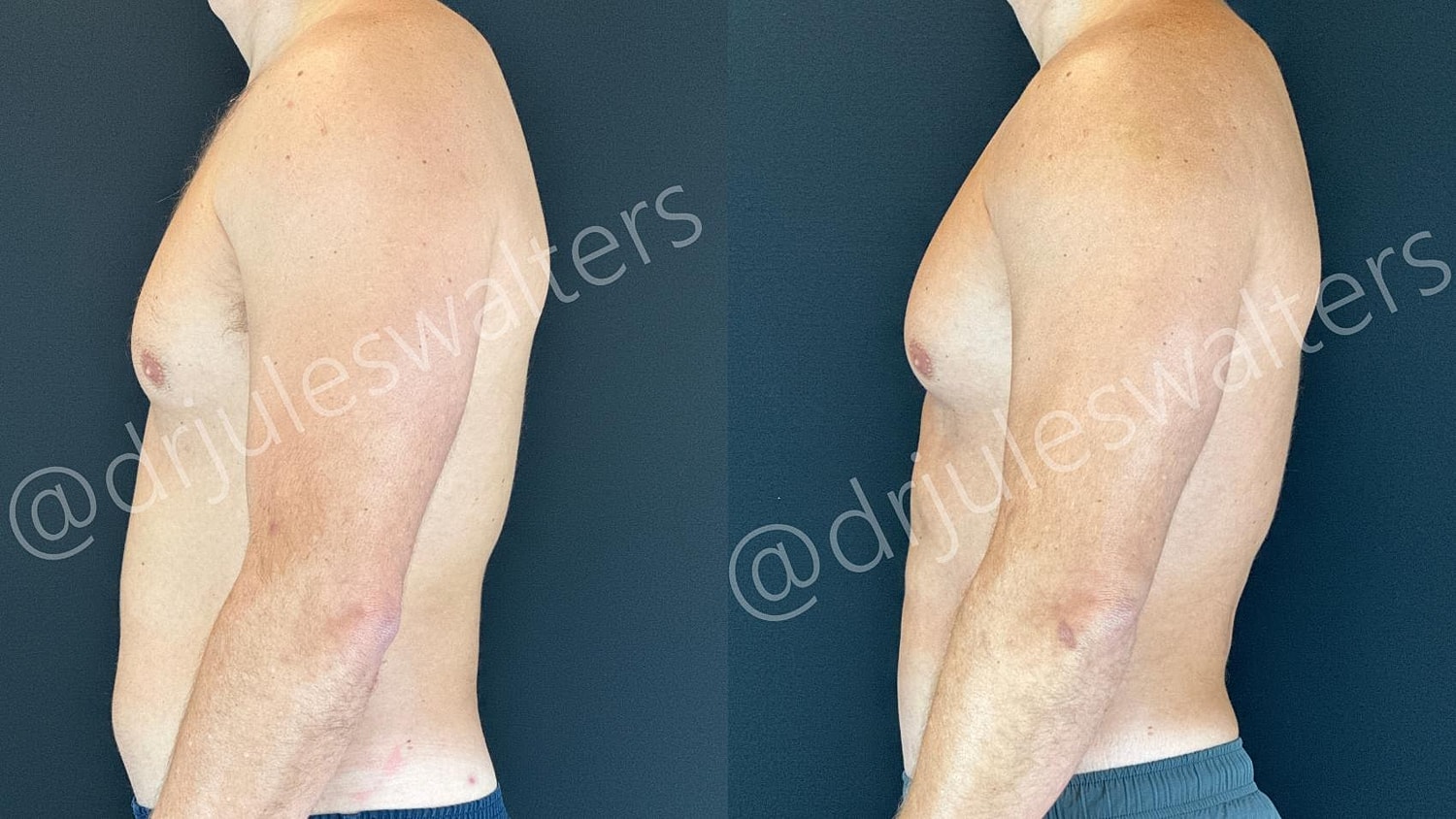 Vaserlipo Before & After