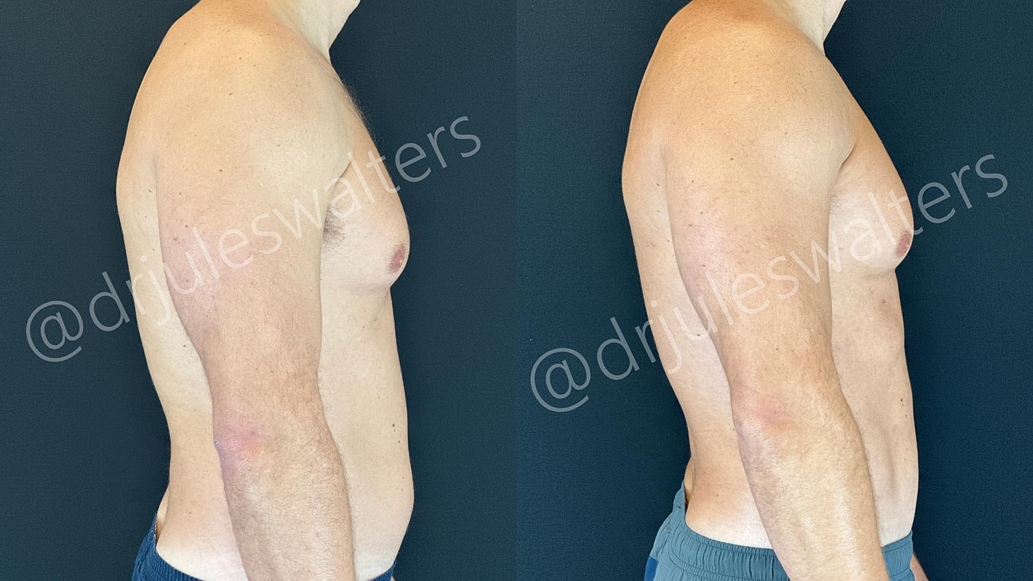 Vaserlipo Before & After