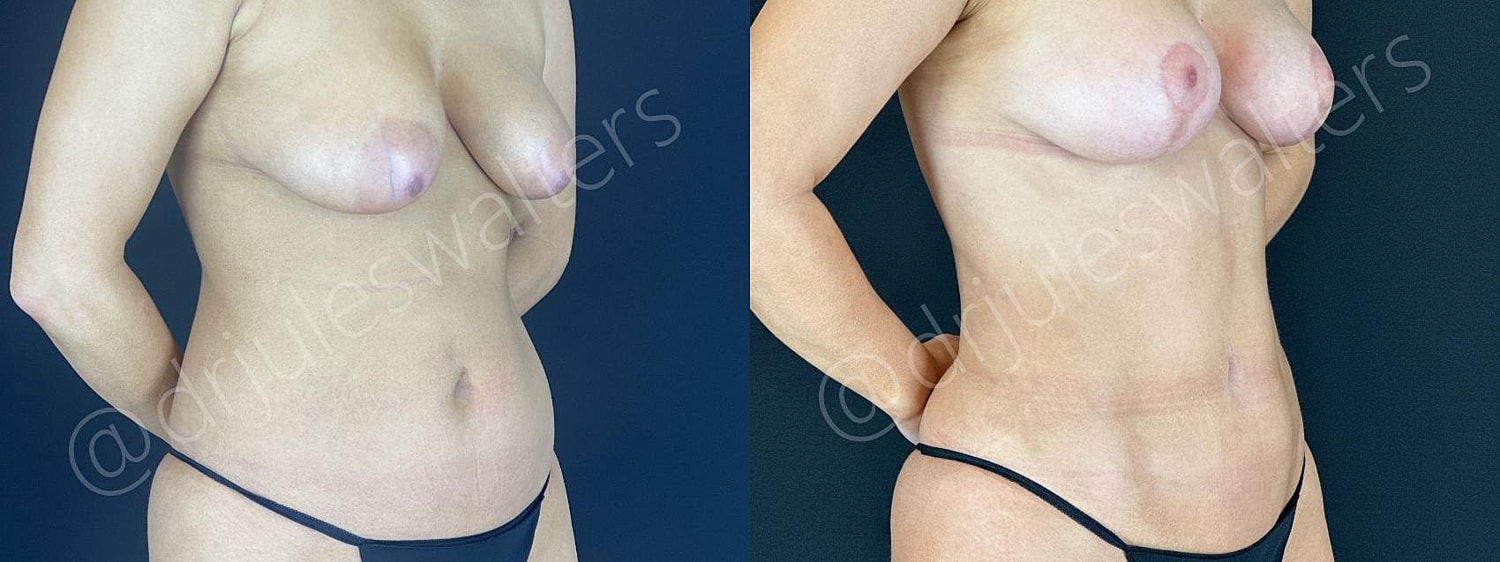 Vaserlipo Before & After