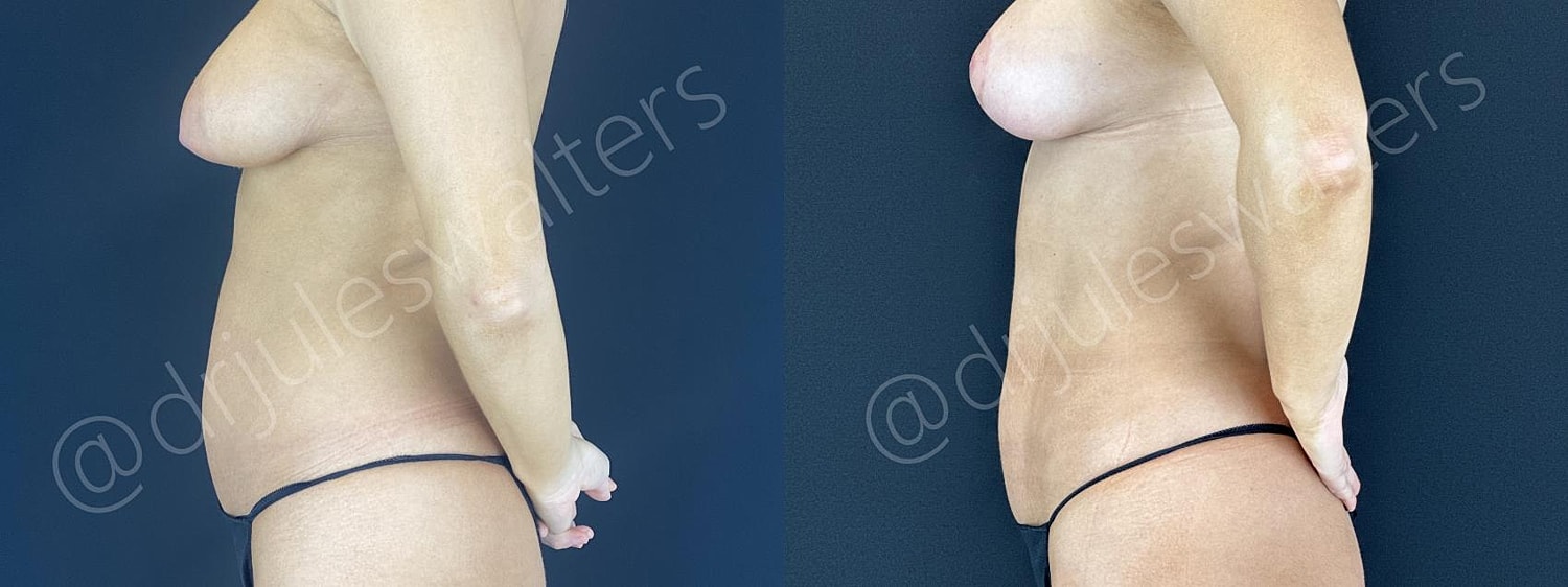 Vaserlipo Before & After