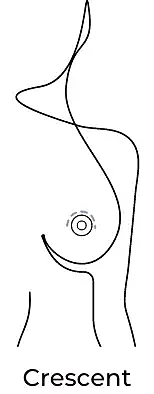 Anchor breast procedure illustration.