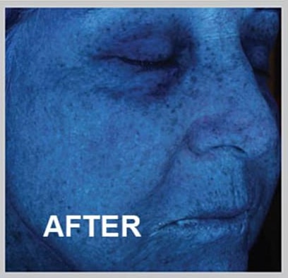 Skin treatment results after procedure or intervention.