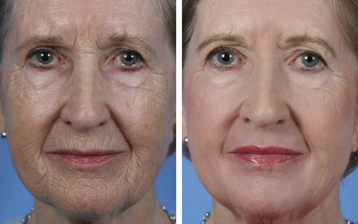 Before and after skincare treatment comparison.